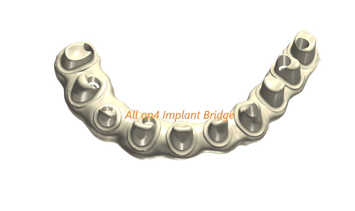 All on4 Implant Bridge